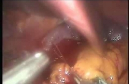 Gastrika breveslerin ayrılmasında kanama