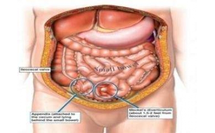 Meckel Divertikülü ve İlişkili Hastalıklar
