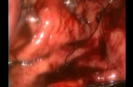 Midenin Adenokanser Dışı Lezyonlarında Minimal Invazif Tedavi Yöntemleri